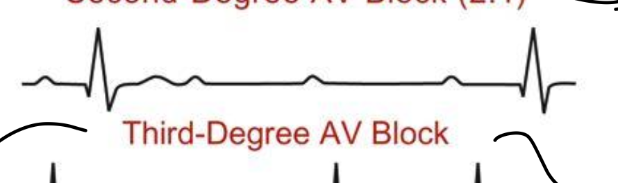 <ul><li><p>complete AV nodal is blocked</p></li><li><p>cannot predict when P wave would become a QRS</p></li></ul><p></p>