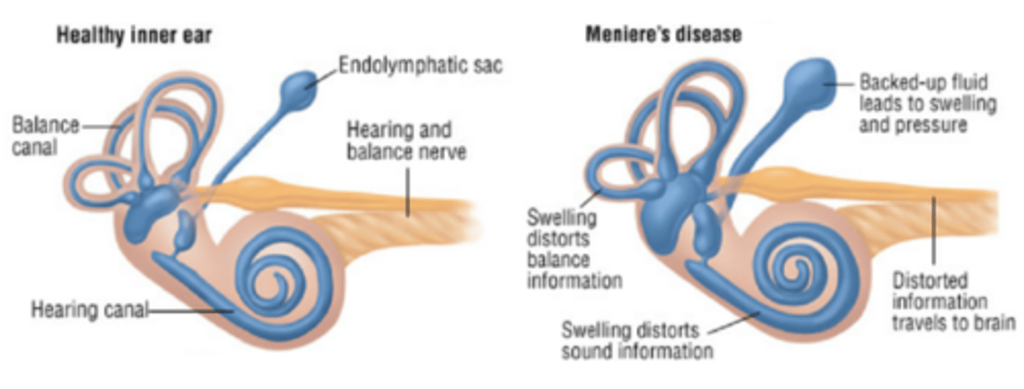 <p>Idiopathic condition affecting the inner ear, in which impaired resorption of endolymphatic fluid causes it to accumulate in the membranous labyrinth (endolymphatic hydrops)</p><p>This leads to excessive pressure and dilation of the endolymphatic system </p><p>More common in females</p><p>Peak incidence: 40–60 years</p>