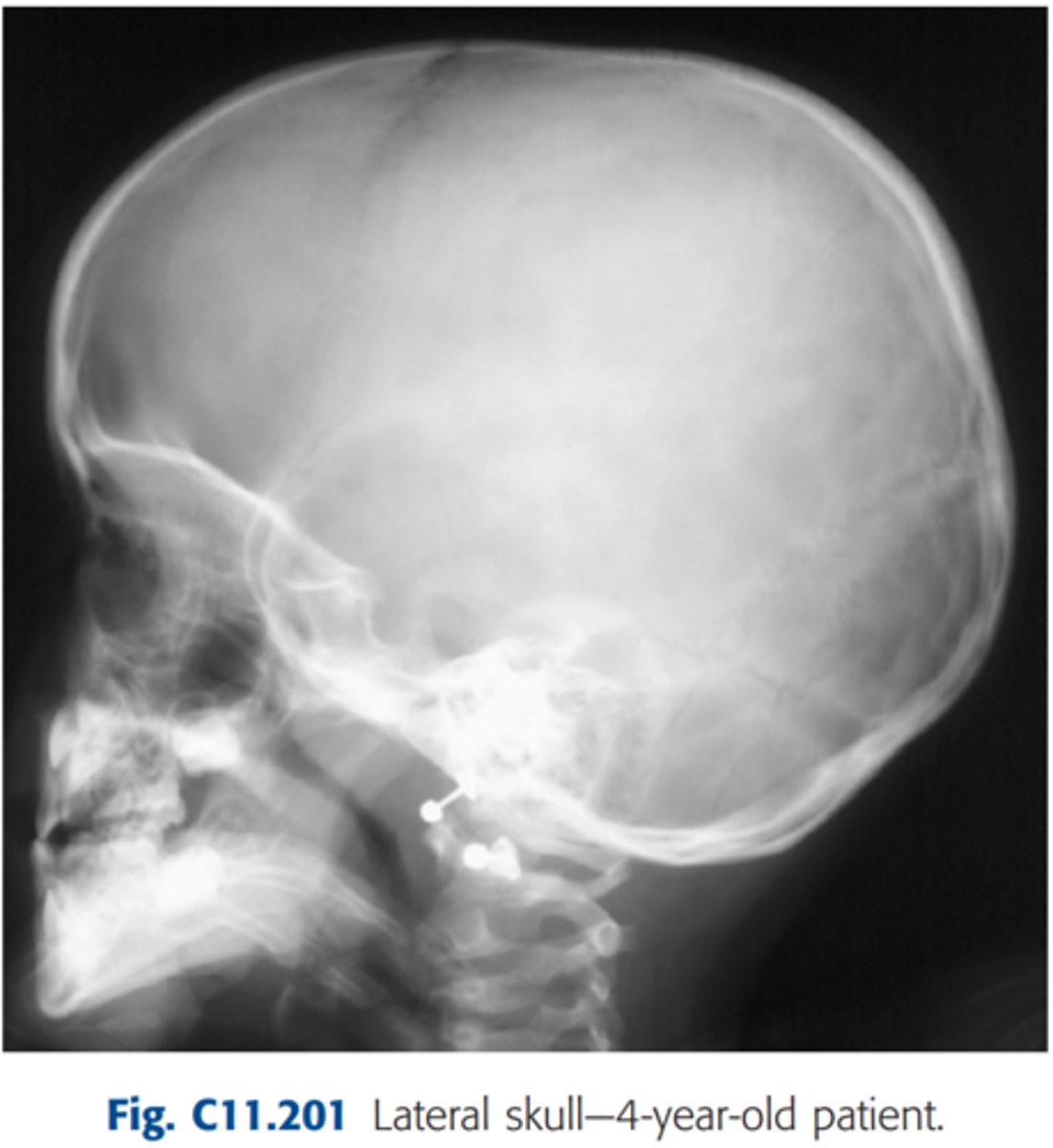 <p>Repeatable errors (three)—</p><p>Criterion 1: Anatomy demonstrated: Foreign bodies (earrings) obscure essential anatomy. </p><p>Criterion 4: Exposure: In most departments, this would be sufficiently underexposed to be repeatable.</p><p>Criterion 5: Anatomic side markers: No anatomic side marker is visible.</p>