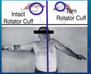 <p><strong>RTC Tears: S/S</strong></p><p>-Moderate to severe pain especially when attempting _________ activity </p><p>-_____ pain </p><p>-Moderate shoulder muscle ____________ → inability to _____ arm, unable to __________ rotate arm against resistance, and drop arm test positive </p><p>-Muscle ________ of shoulder</p>