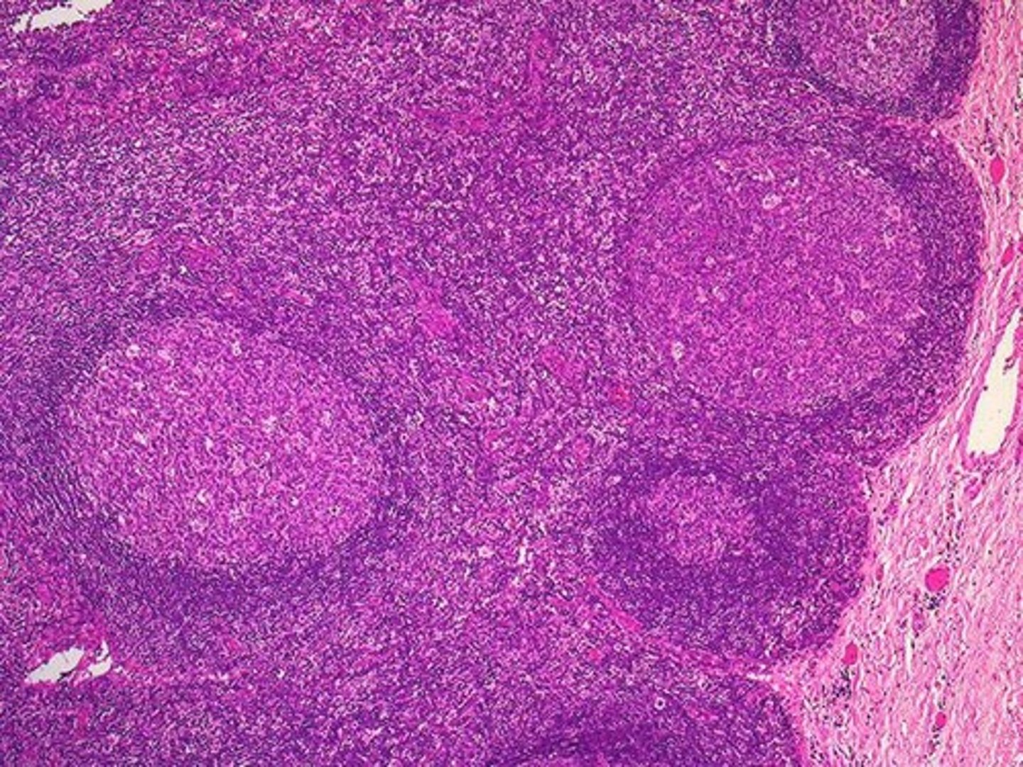 <p>Acute nonspecific lymphadenitis is caused by infections and is usually painful.</p>