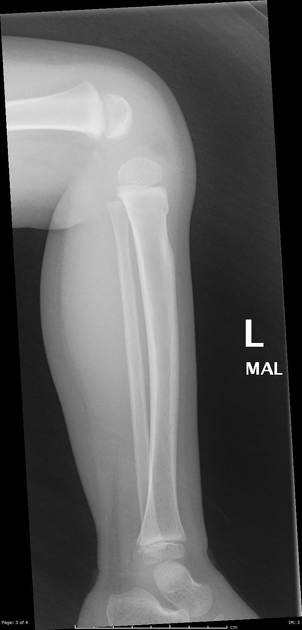 <p>Describe the abnormality demonstrated.</p>