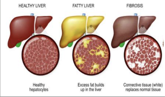 <ul><li><p>widespread inflamm and destruction of liver tissue </p></li><li><p>fibrosis → scar tissue replaces healthy liver tissue </p></li><li><p><strong>may be REVERSIBLE</strong> with abstinence </p></li></ul><p></p>