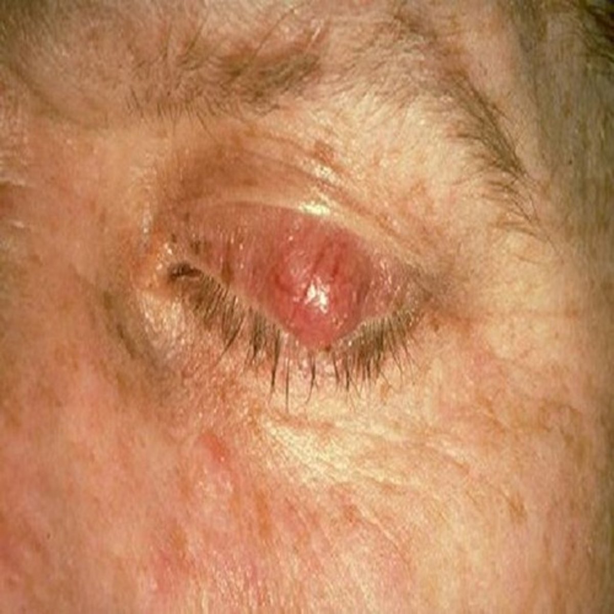 <p>scar tissue on the eyelid that can grow over a period of time (slow growing)</p>
