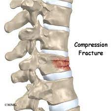 occur in vertebrae subjected to extreme stresses(osteoporosis)