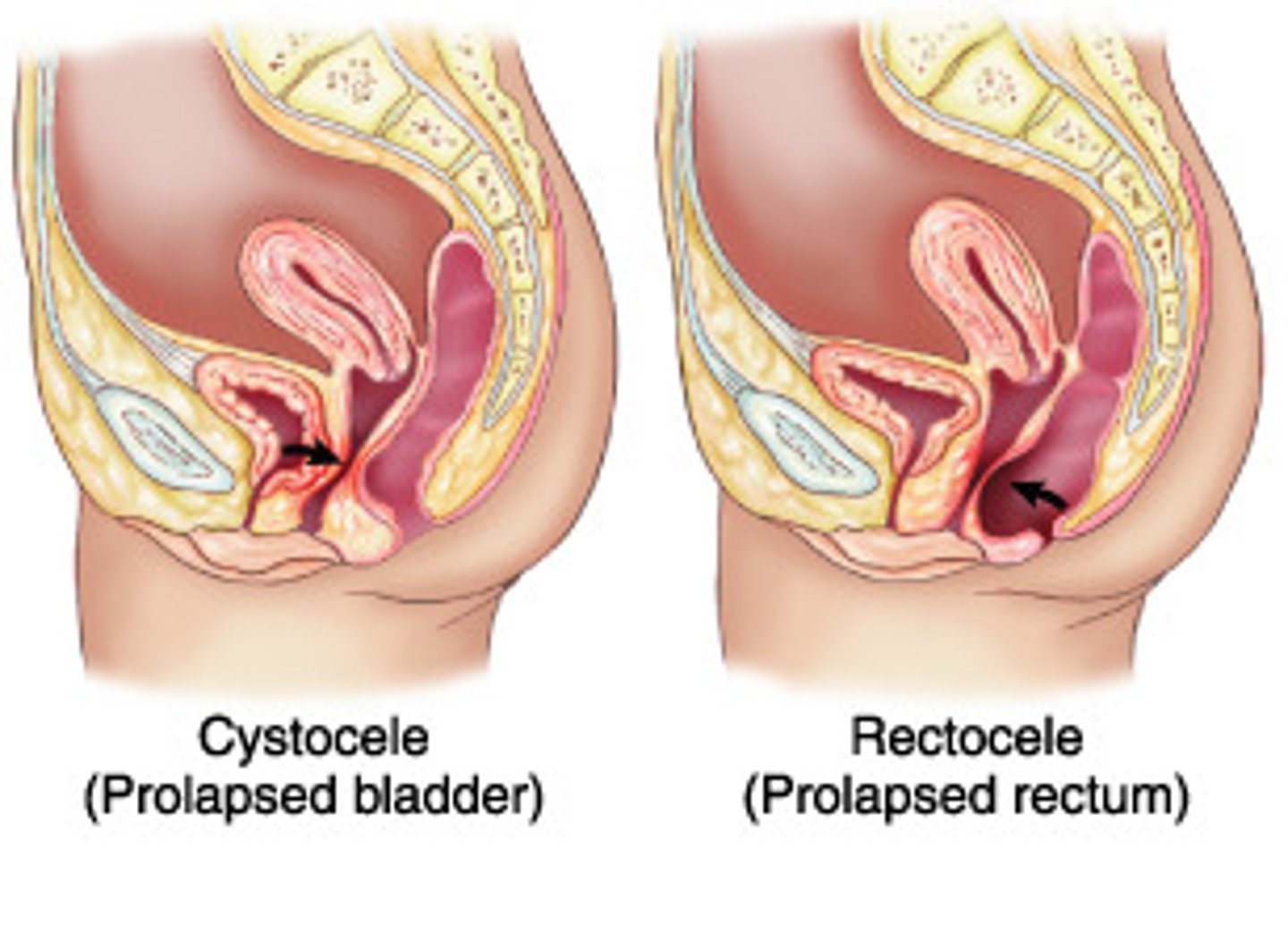 <p>bladder prolapse</p><p>vaginal hernia where bladder drops down into vagina causing soft anterior fullness</p><p>may be accompanied by urethrocele due to detachment from pubic symphysis during childbirth</p>