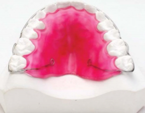 <p>Need to settle occlusion- no wire framework across teeth </p>