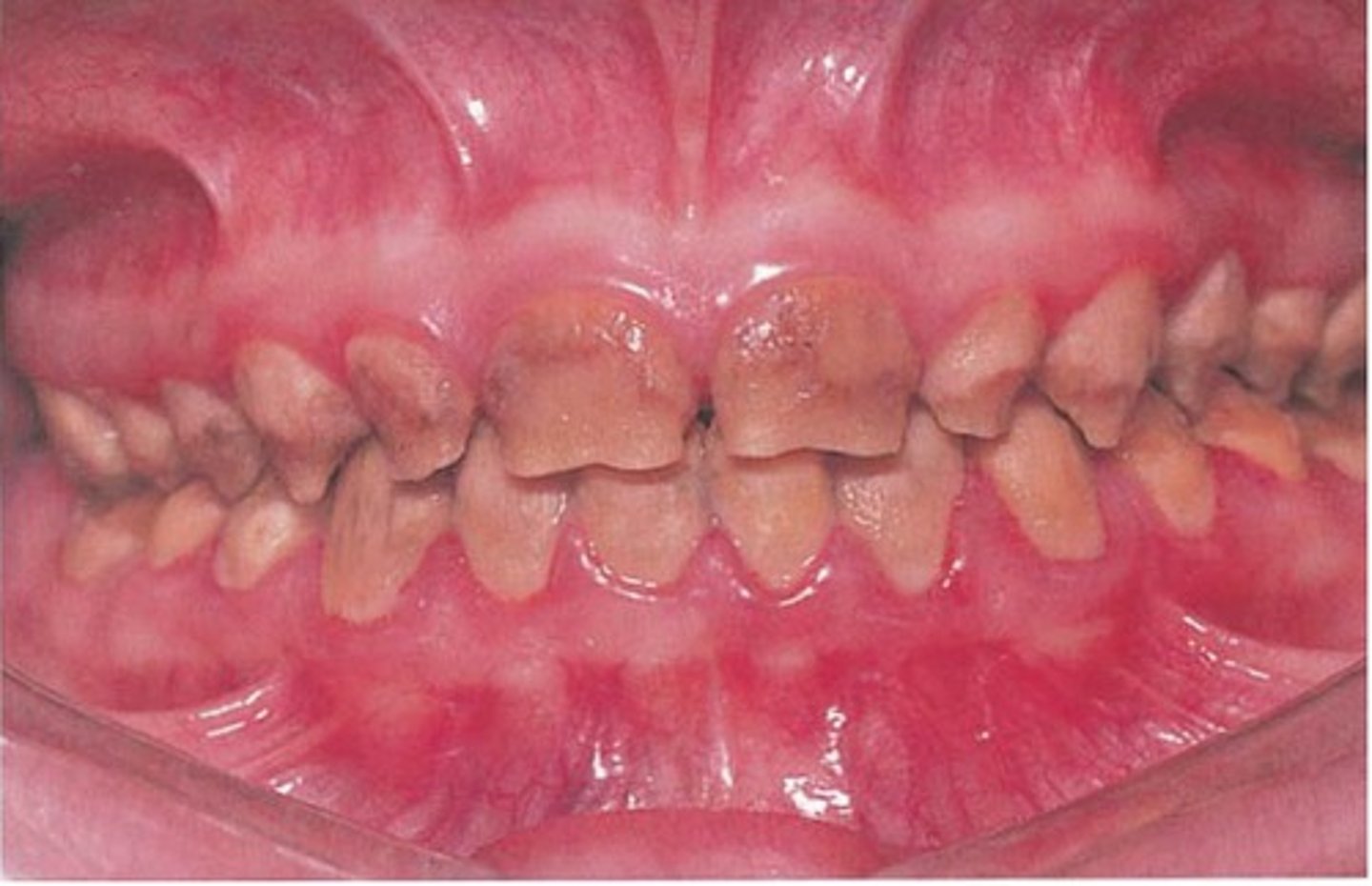 <p>-Hereditary defect of enamel formation</p><p>-Enamel hypoplasia, pits and/or grooves in teeth</p><p>-Teeth often discolored</p><p>-Different subtypes</p>