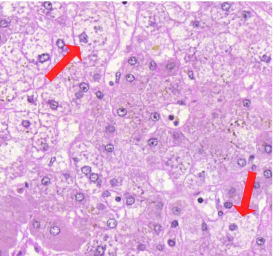 <p>millaista degeneraatiota kuvassa näkyy? (vinkki: maksaskirroosi)</p>