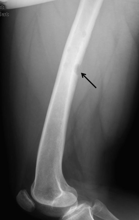 <p>What does this x-ray indicate?</p>