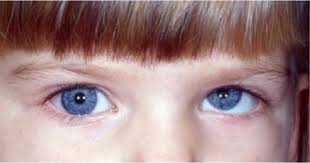 <p>Trochlear (IV) Palsy</p>