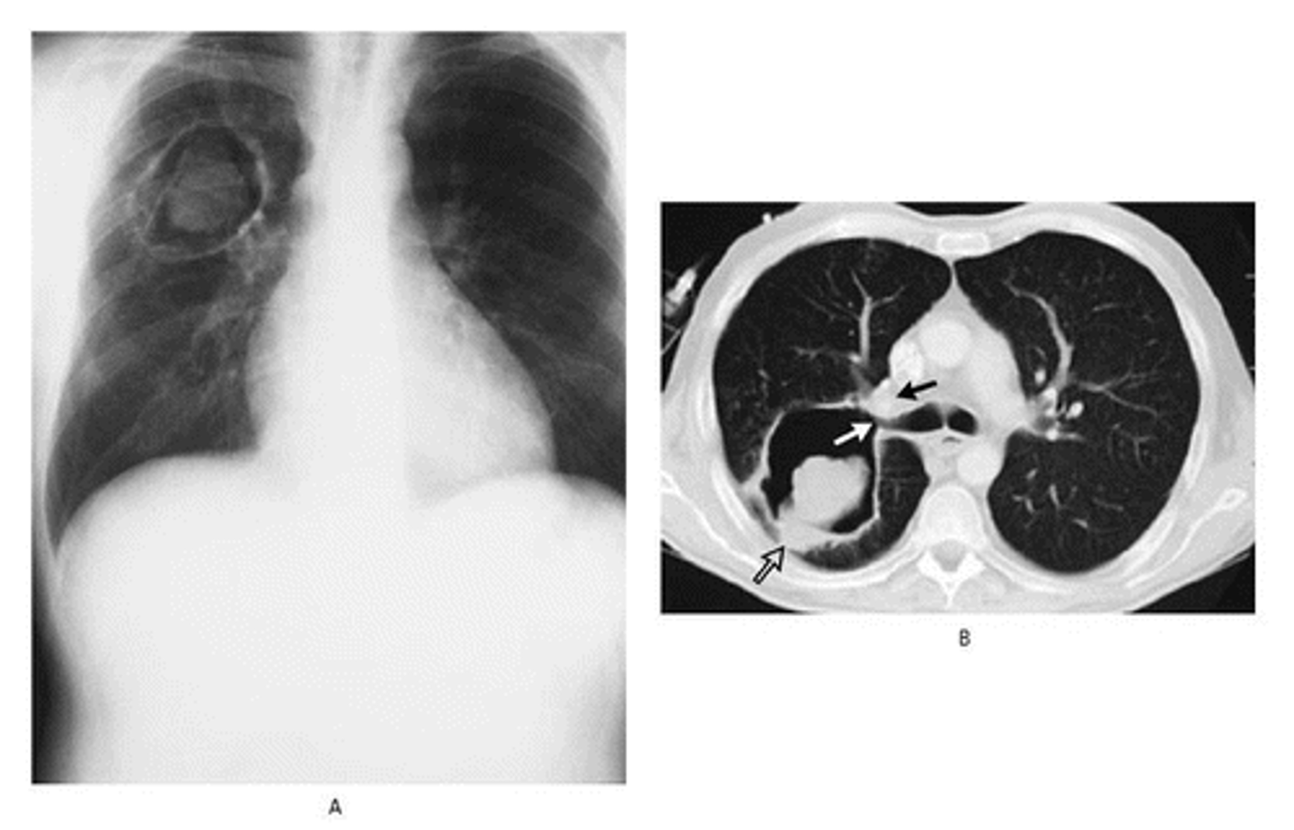 <p>The formation of a "fungus ball" within preexisting cavities</p>