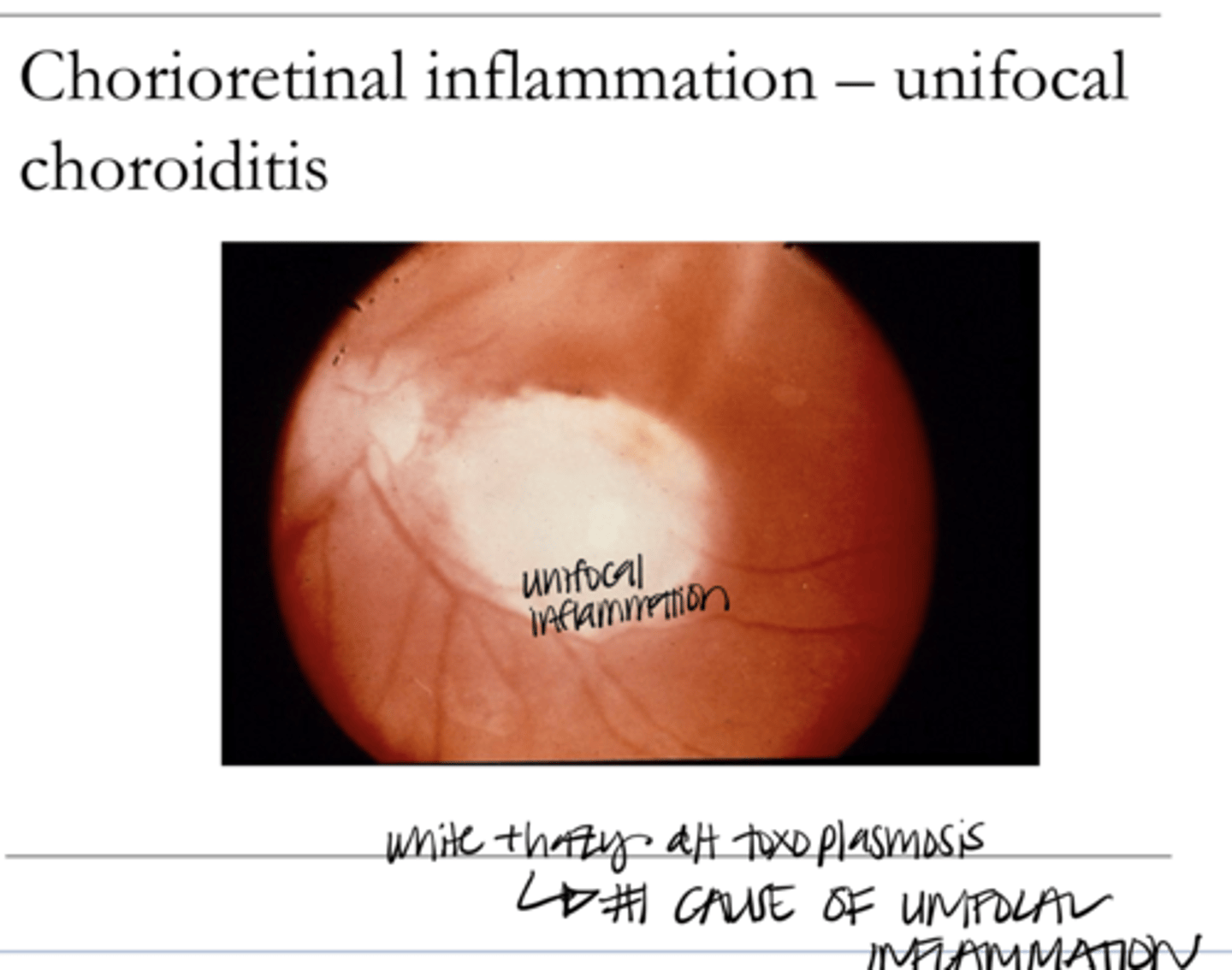 <p>Chorioretinal Inflammation -- Unifocal Choroiditis (Pic)</p>