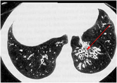 <p>The pathology in this image is seen radiographically as</p>