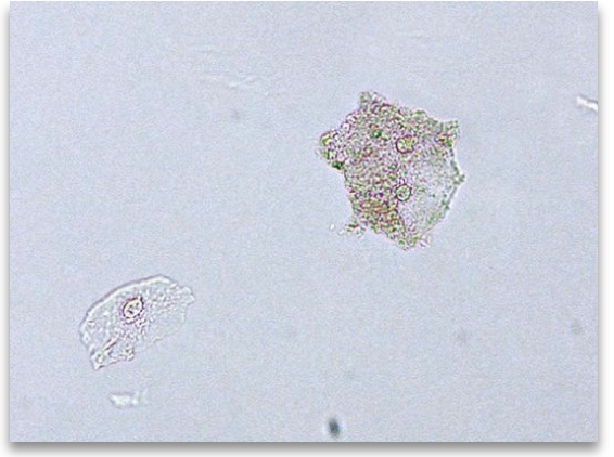 <ul><li><p class=""><span style="color: red"><strong>Squamous epithelial cells</strong></span><span style="color: #06e127"> coated with <strong>Gardnerella vaginalis</strong></span></p></li><li><p class="">Appear<span style="color: red"> <strong>granular and irregular</strong></span></p></li><li><p class="">Indicative of <span style="color: #e9fa0a"><strong>bacterial vaginosis</strong></span> (when numerous)</p></li><li><p class=""><span style="color: #fa0606"><strong>Not typically reported</strong> on urine microscopy</span> — seen on <strong>vaginal wet preps</strong></p></li></ul><p></p>