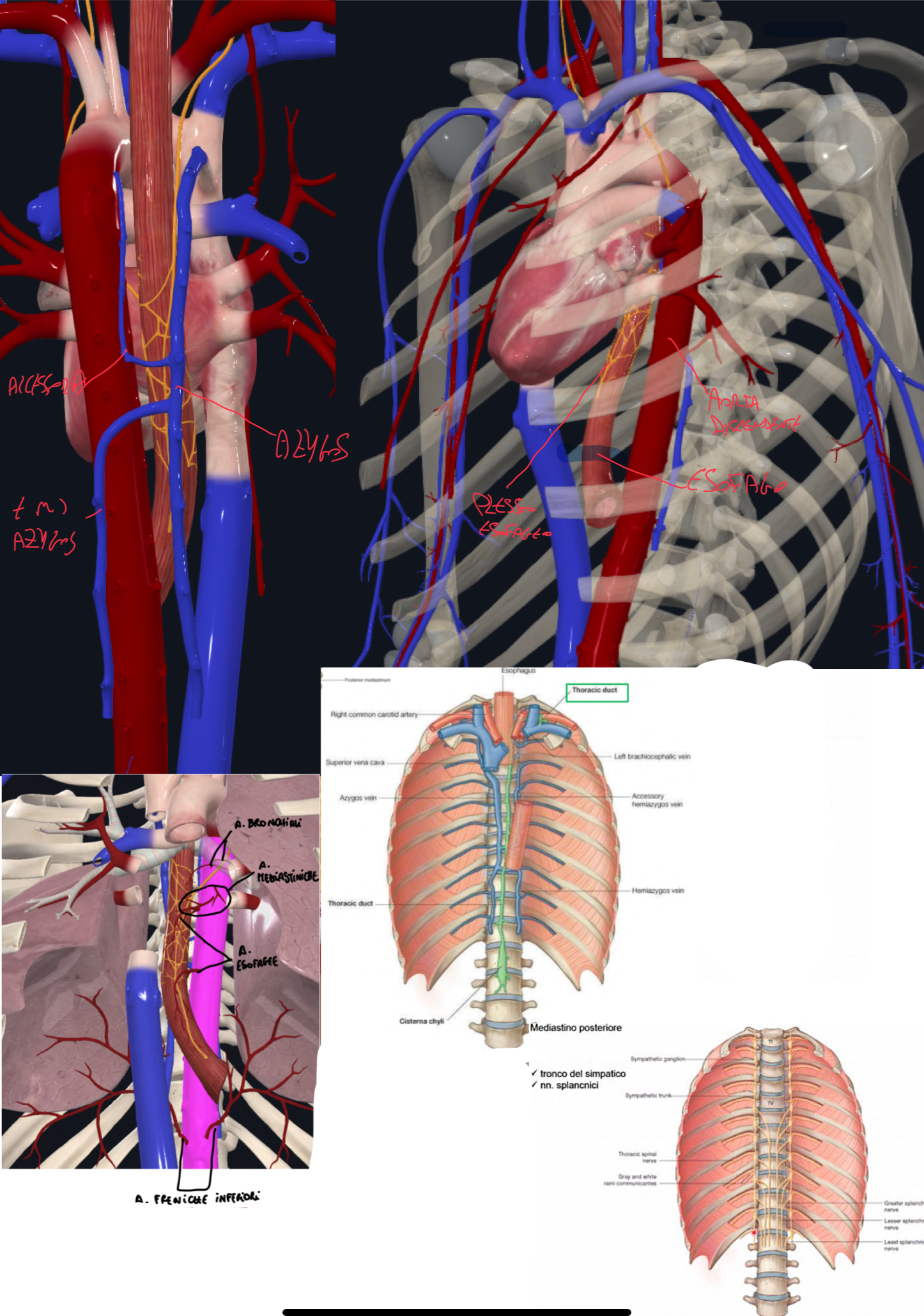 <p>Contenuto mediastino posteriore:</p><ul><li><p>Aorta discendente toracica → posteriormente al cuore, da cui originano:</p><ul><li><p>Arterie intercostali posteriori</p></li><li><p>Rami viscerali → a. esofagee, bronchiali, mediastiniche, freniche inferiori</p></li></ul></li><li><p>Esofago → che scende dal mediastino superiore posteriormente al cuore, attraversa il diaframma e raggiunge lo stomaco e cavità addominale</p><ul><li><p>L’esofago è accompagnato dal plesso esofageo formato dai nervi vaghi che incrociano posteriormente i peduncoli polmonari, si portano sull’esofago ramificando e formando il plesso esofageo</p></li><li><p>Poi distalmente, avvicinandosi al diaframma, le fibre formano un Tronco vagale anteriore e posteriore</p></li></ul></li><li><p>Vena Azygos e Emiazygos (e emiazygos accessoria) → rispettivamente a destra e sinistra della colonna vertebrale</p><ul><li><p>La azygos forma un arco sopra il bronco principale destro e sbocca nella faccia posteriore della vena cava superiore</p></li><li><p>La emyazigos si unisce alla azygos a livello di T8</p></li><li><p>La emyazigos accessoria si unisce alla azygos a livello di T7</p></li></ul></li><li><p>Dotto Toracico:</p><ul><li><p>Origina dalla cisterna del chilo anteriormente a L1-2 che origina dalla confluenza di dotti linfatici intestinali e dotto lombare sx e dx (riceve la linfa dalla zona sottodiaframmatica del corpo).</p></li><li><p>Poi attraversa il diaframma (dallo iato aortico) passa posteriormente all’aorta ed esofago, inizialmente a dx poi si posta a sx della colonna.<br>Infine a livello dell’apertura toracica superiore fa un arco sopra la succlavia e termina nell’angolo venoso (ha aspetto a collana per le numerose valvole)</p></li></ul></li><li><p>Tronco del simpatico → decorre ai lati della colonna, quindi scende dal mediastino superiore, poi in quello posteriore. A livello toracico presenta i gangli toracici e poi i nervi splancnici</p></li></ul><p></p>