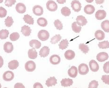 <ol start="44">
<li>What does a crenated rbc look like</li>
</ol>