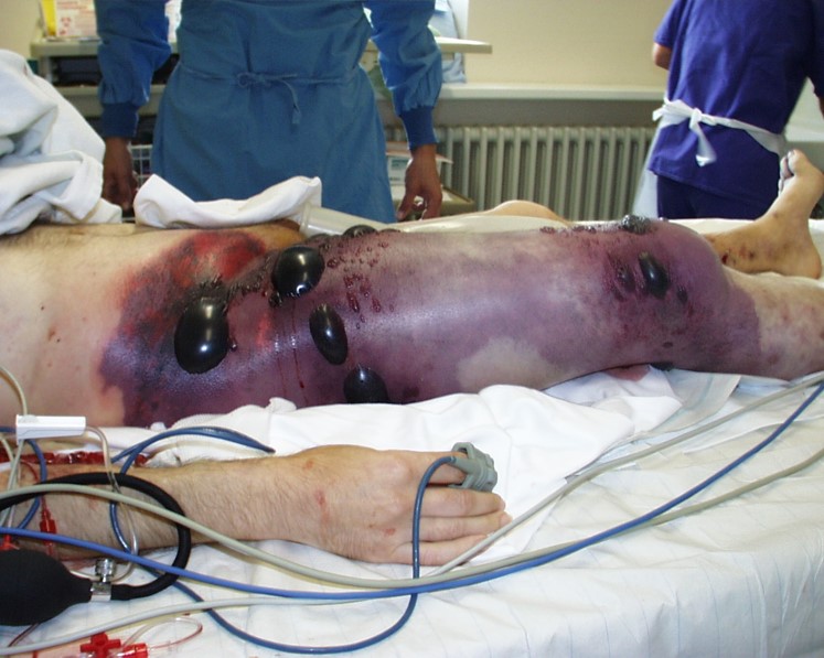 what type of gangrene is this?
