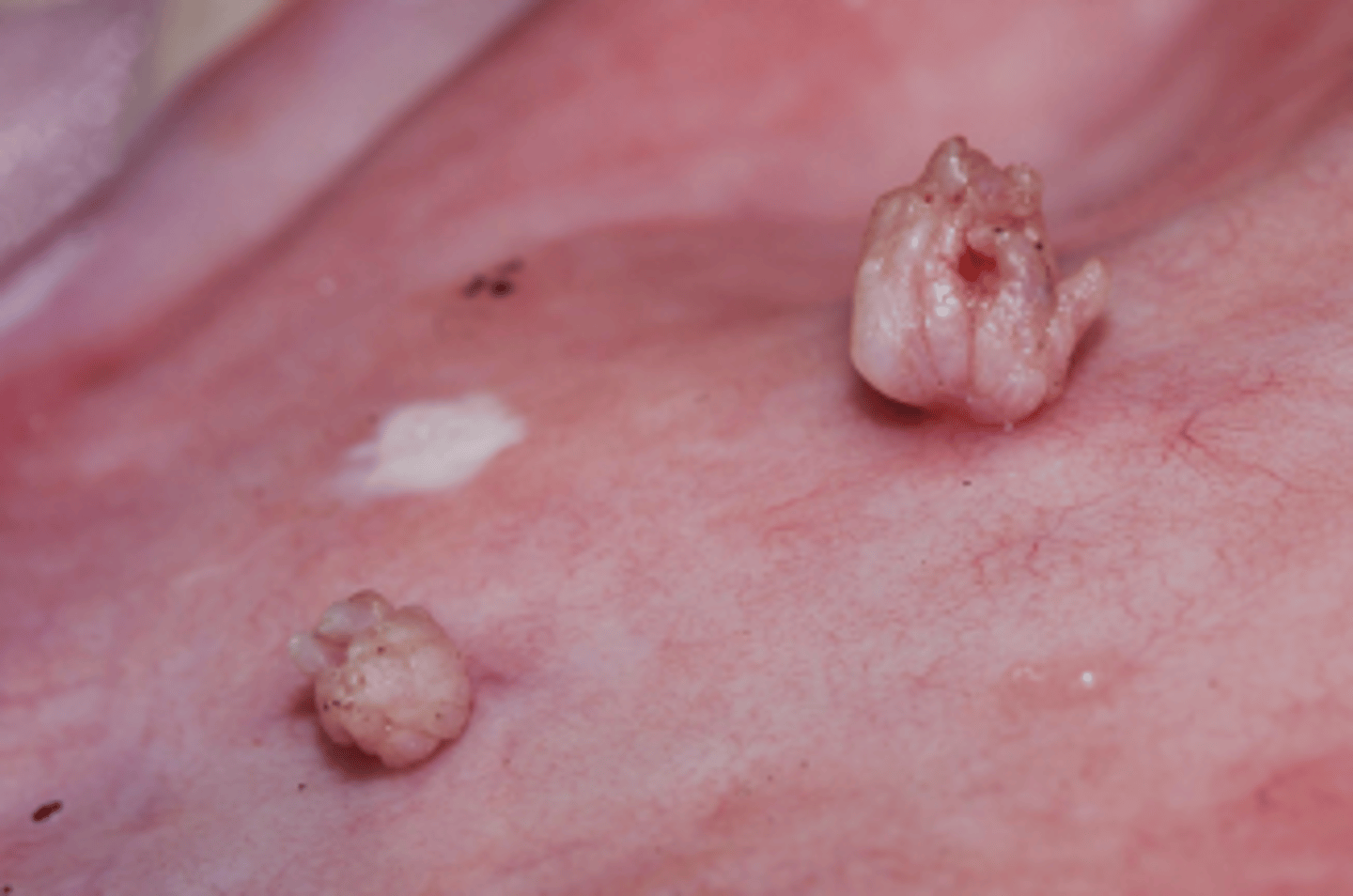 <p>- A benign proliferation (histological fronds of stratified squamous epithelium) caused by papillomaviruses (dsDNA viruses) which occur in various regions in the oral cavity and throughout the GI tract.</p>