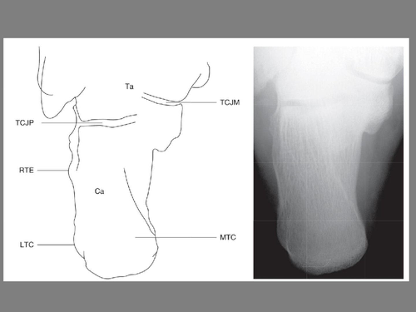 <p>Plain films include an AP view, lateral view and oblique view</p><p>- <strong>______________</strong> is needed for suspected calcaneal fracture</p>