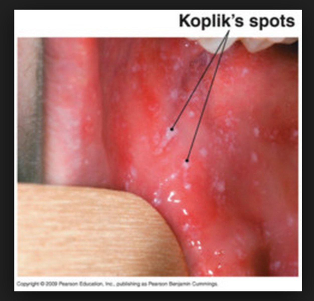 <p>Koplik spots in the oral cavity and skin rash that results from a paramyxovirus</p>