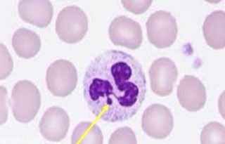 <p>Drumstick or club-like appendage of the nucleus</p><p>Only seen in females</p><p>Remnant of an inactivated X chromosome</p>