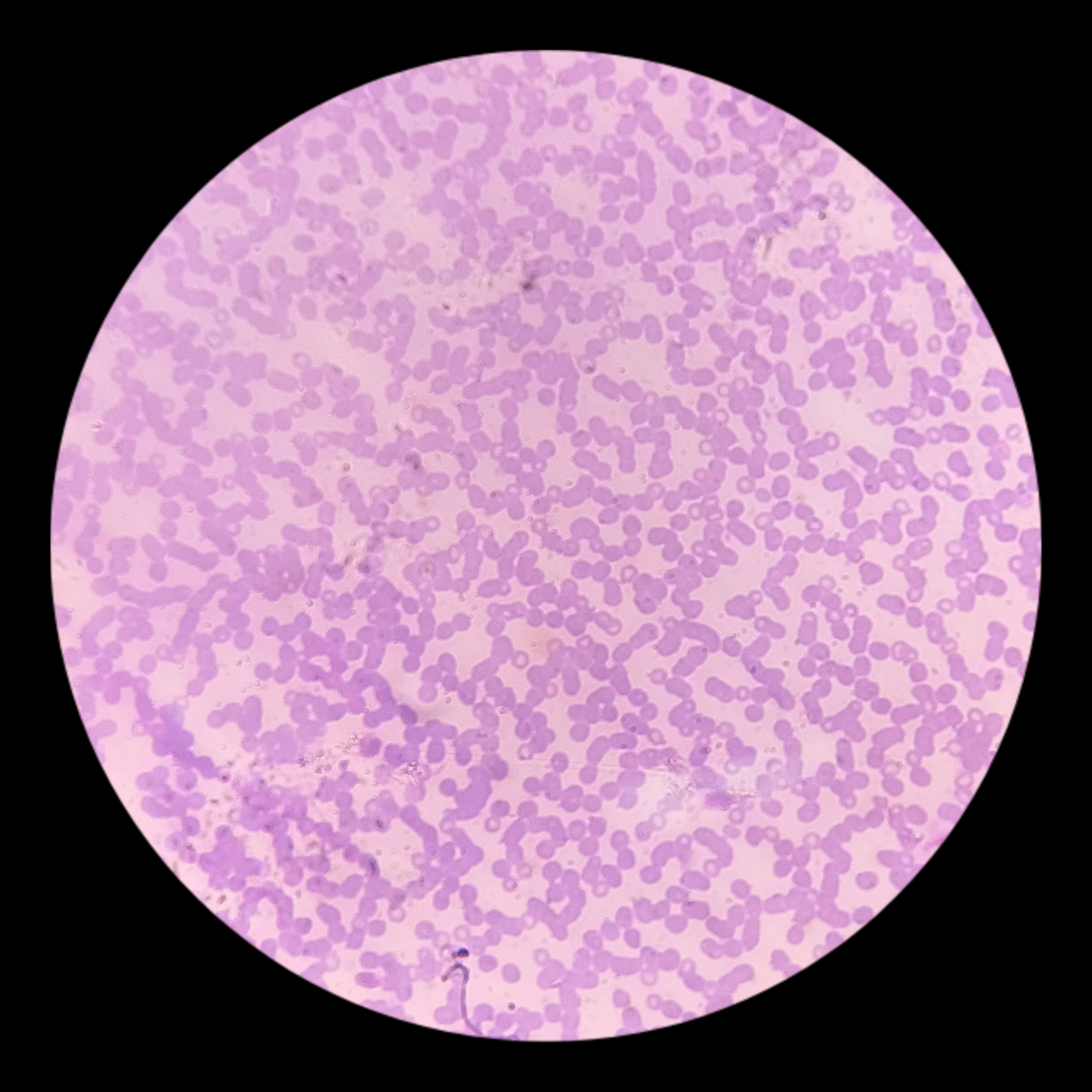 <p>Disease that <em>Plasmodium malariae </em>can cause.</p>