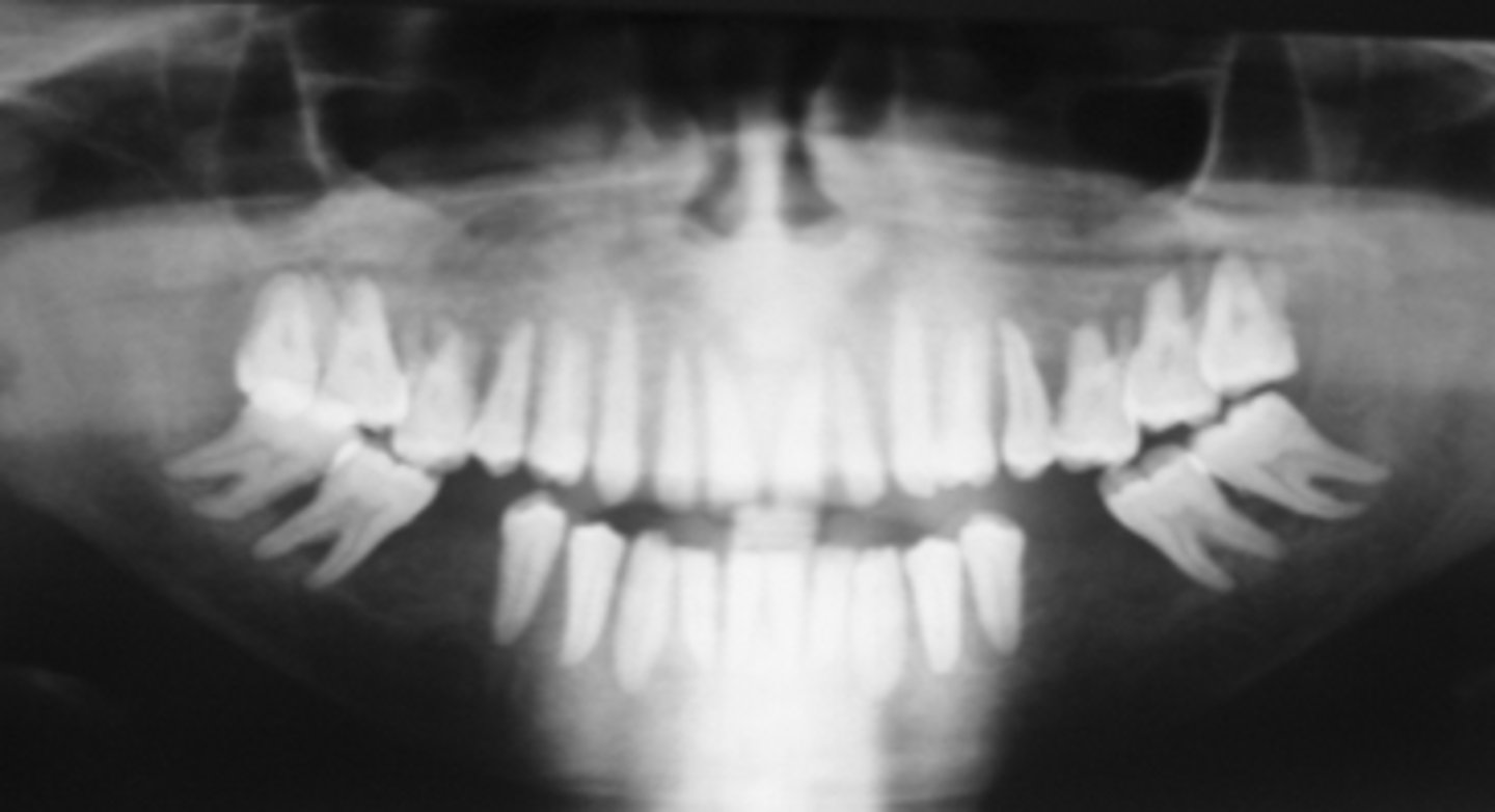 <p>describe the changes in bone density from this pano:</p>