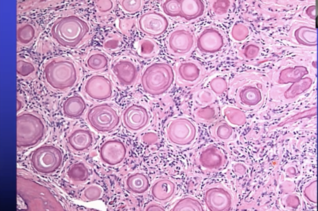 What are the tumours of the meninges called and what are there main characteristics ? 