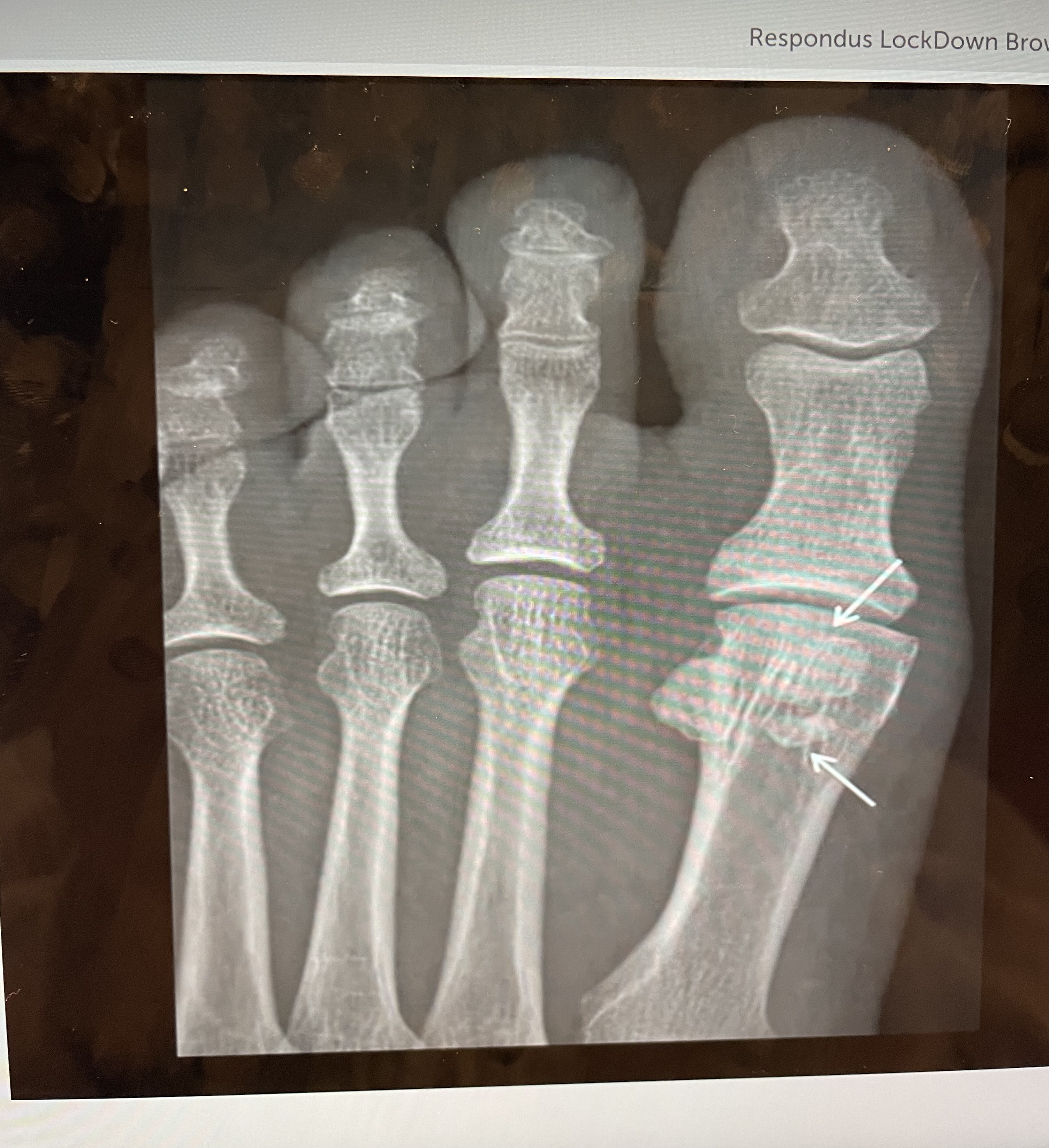 The bones indicated by the above X-ray are classified as 