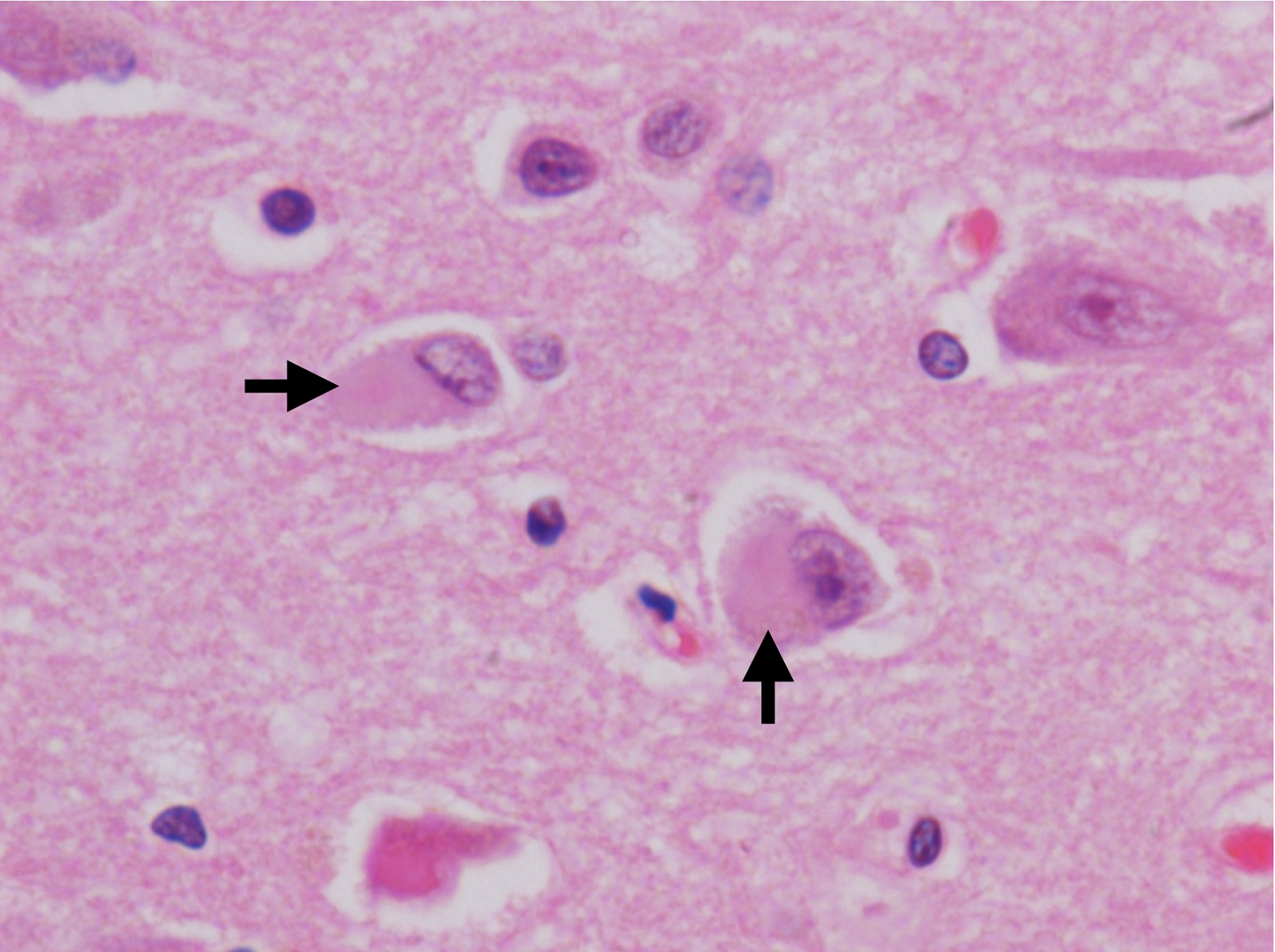<p>A “lewy body” is…</p><p></p><p><span>an <strong>abnormal clump of protein</strong> (specifically <strong>alpha-synuclein</strong>) that forms <strong>inside nerve cells in the brain</strong></span></p>