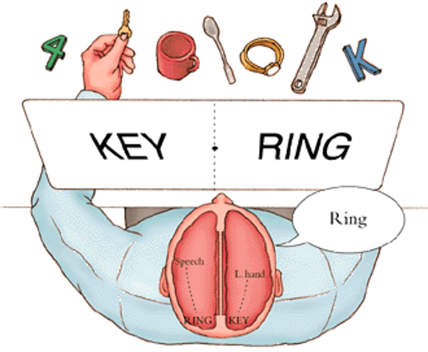 <p>procedure that involves severing the corpus callosum to reduce the spread of epileptic seizures</p>