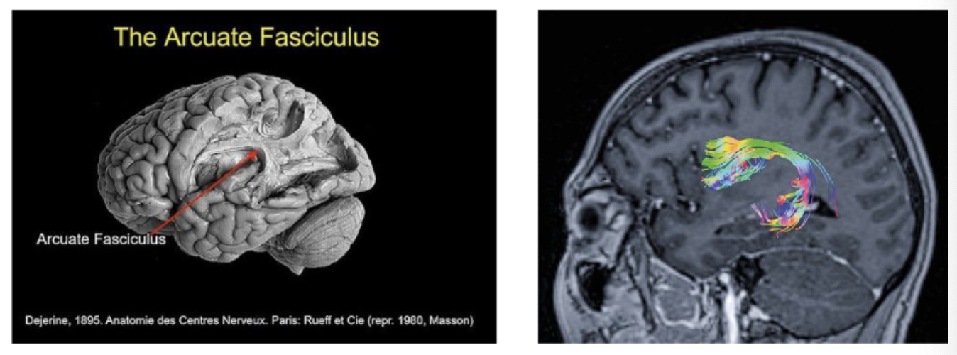 <p><span><span>In language processing, </span><em><span>Wernicke’s area</span></em><span> (related to interpreting an auditory code) is strongly connected to distant </span><em><span>Broca’s area</span></em><span> (related to speech production) via a dense bundle of axons, </span><strong><span>the Arcuate Fasciculus</span></strong><span>.</span></span></p>