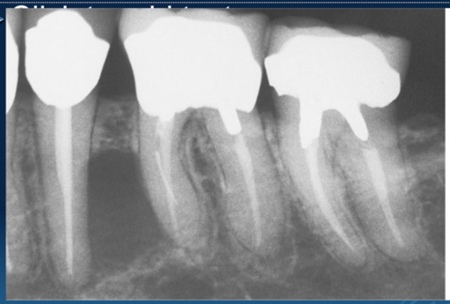 <p>inflammatory cyst appearing along the lateral aspect of the root</p>