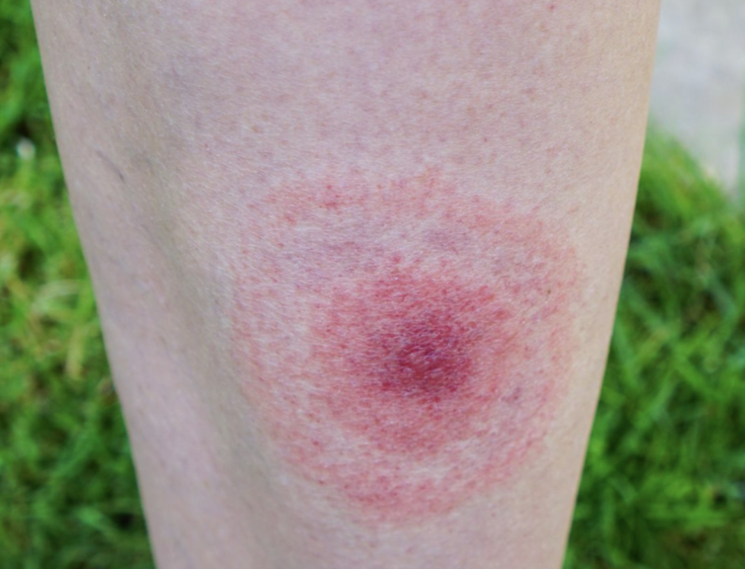 <p>feed on the blood of humans and animals, holds on firmly to the host and can be removed by fine tweezers</p><ul><li><p>can transmit diseases (Rocky mountain fever and Lyme disease)</p></li><li><p>Bullseye rash</p></li></ul><p></p>