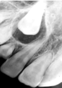 <p>AOT and Dentigerous Cyst affect unerupted teeth and the radiolucency attaches at the ACJ</p><p>In AOT the radiolucency will have calcifications in it therefore have small radiopacities.</p>
