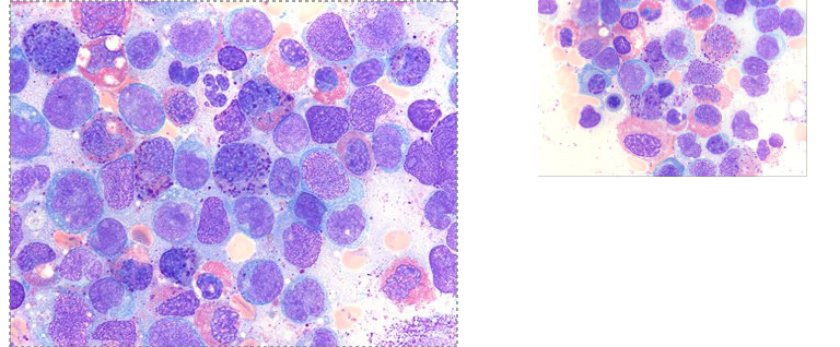 <p>predominance of monoblasts in BM, PB</p><p>usually kids</p><p>gum infiltration common</p>