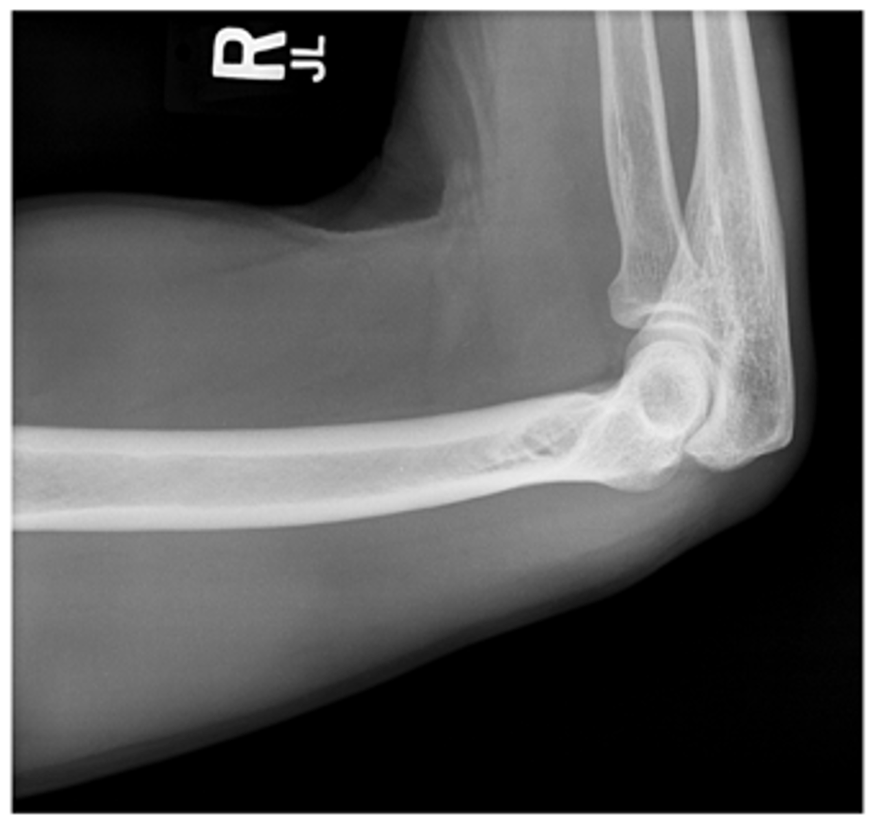 <p>- Mid and distal humerus</p><p>- Distal ⅔ humerus demonstrated</p><p>- 90° perspective from AP projection</p><p>- Epicondyles superimposed</p><p>- Exposure factors</p>