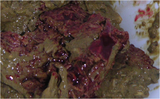 <p>Hematochezia</p>