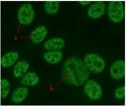 <p>This antinuclear antibody (ANA) pattern is characterized by granular staining in the nuclei of the interphase cells (a). There is also an absence of staining in the chromosomal area of the metaphase mitotic cells (b). The slide is viewed using fluorescent microscopy. </p><p>A. Homogeneous </p><p>B. Speckled </p><p>C. Nucleolar </p><p>D. Centromere</p>