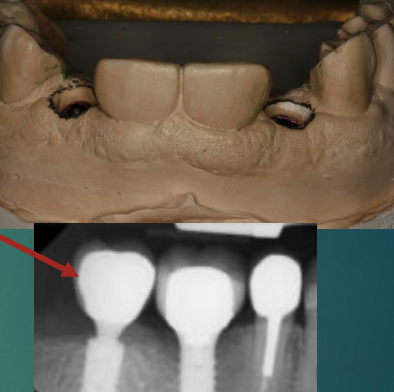 <p>What will stone model contouring do?</p>
