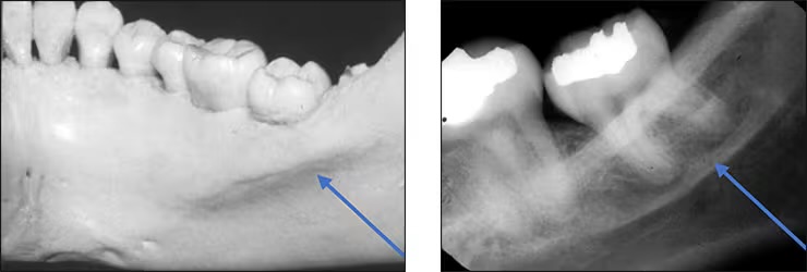 <p>Mandibular canal</p>