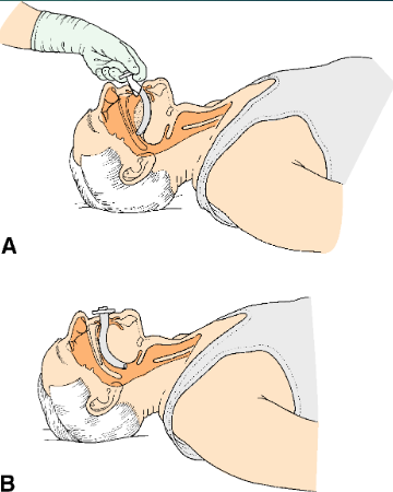 <p><span style="background-color: transparent;">(often used with unconscious patients)&nbsp;</span></p><ul><li><p><span style="background-color: transparent;">Need to be very careful with oral cleaning, be aware of placement and proper cleaning to prevent VAP (ventilation acquired pneumonia)&nbsp;</span></p></li><li><p><span style="background-color: transparent;">Sized from mouth to corner of jaw&nbsp;</span></p></li></ul><p></p>