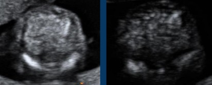 <p>Both images were taken with the same fetus at the same area, just with different gains. </p><p>What can be assumed regarding what is seen here?</p>