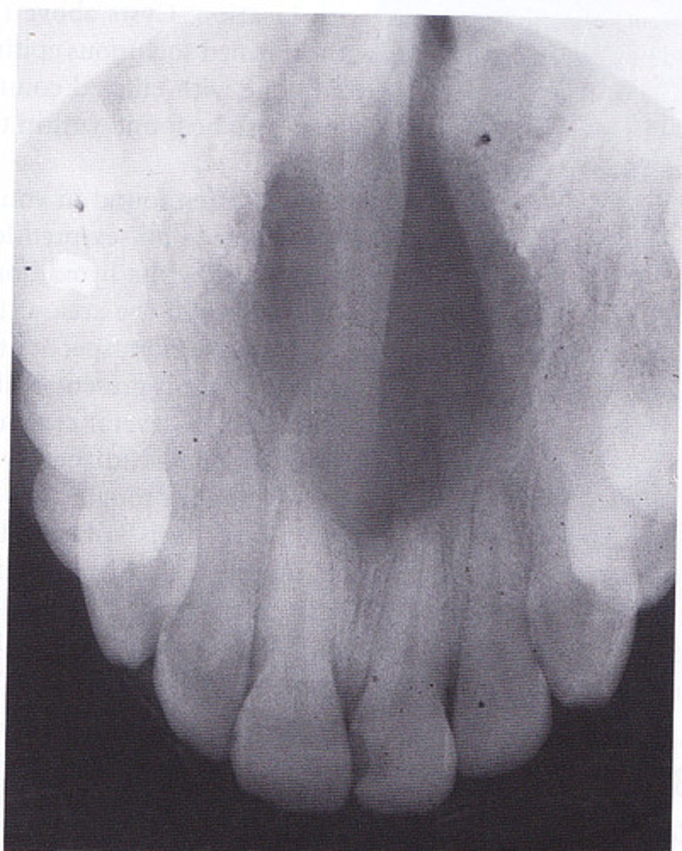 <p>1. midline of hard palate - behind incisive papilla</p>
