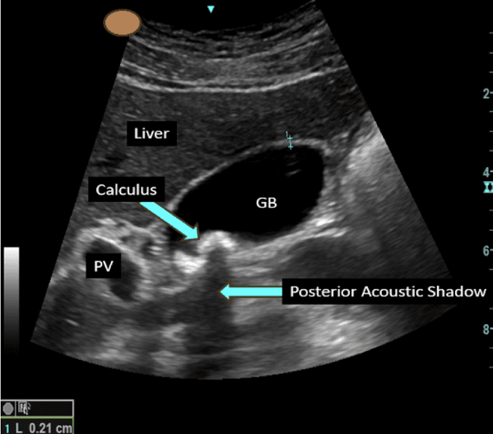 <p><strong>paroxysms of pain due to biliary outflow obstruction causing increased intraluminal pressure and gallbladder spasm</strong><br><em>risk factors: </em><strong>AFAB</strong>:AMAB 2:1, physical inactivity, obesity, insulin resistance, GLP-1, gallbladder hypomotility (fasting, rapid weight loss)</p><p>S/S: <strong>epigastric and RUQ pain (post-prandial, 1-2 hours after meal)</strong>, nausea, vomiting, pain radiates to back/right infrascapular<br>PE: often normal, sometimes RUQ tenderness</p><p>Dx: <strong>RUQ ultrasound: gallstones or sludge in gallbladder</strong>; <br><em>Labs</em>: <strong>↑ALP, ↑bilirubin </strong>suggests ductal obstruction</p><p>Tx: analgesia, <strong>early or interval laparoscopic cholecystectomy</strong></p>