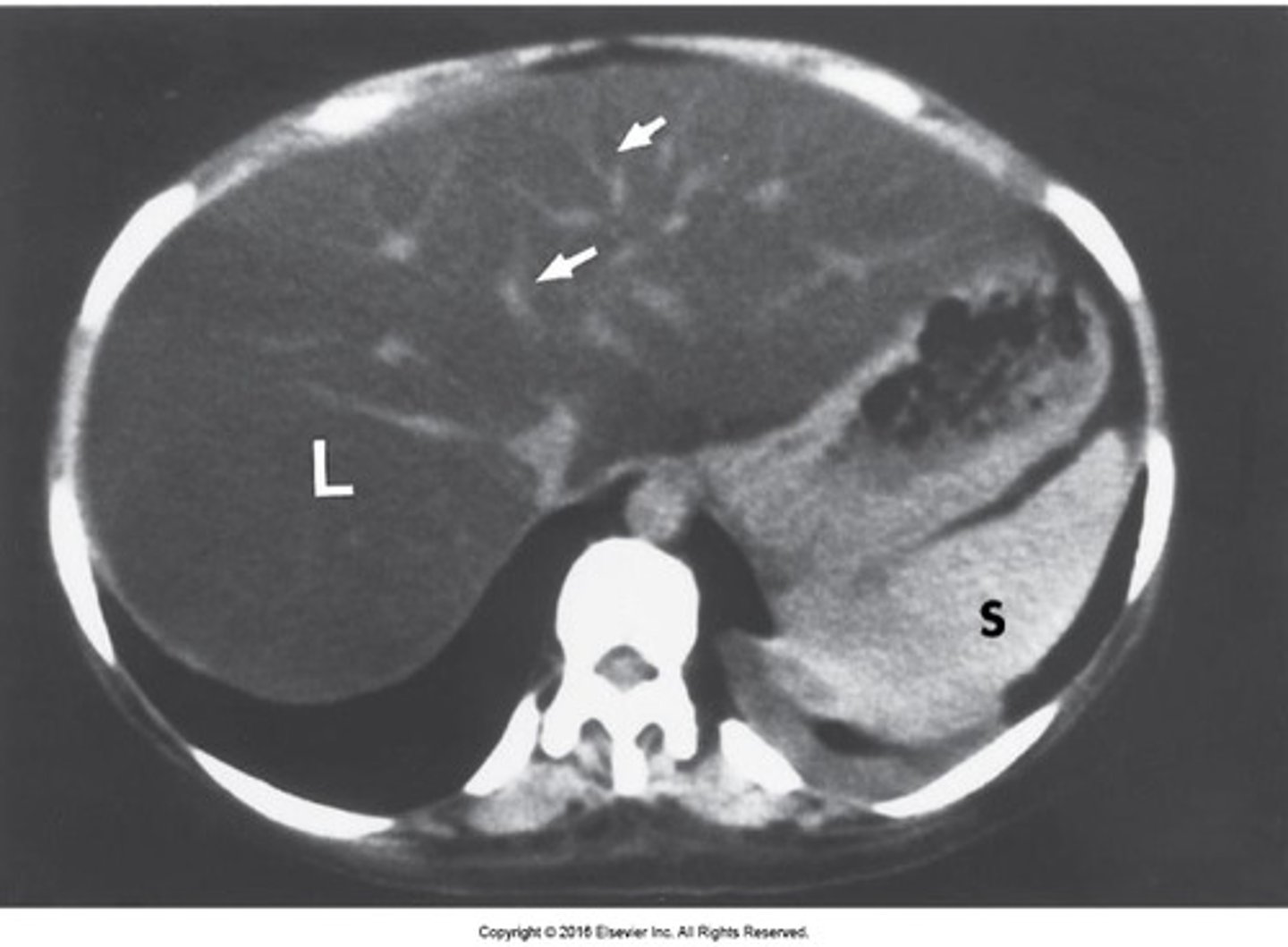 <p>focal or diffuse fatty infiltration appears as less dense on CT</p>