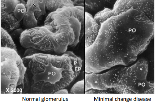 <p>Minimal Change Disease</p><p>Compare the podocytes in these scanning electron microscopy images:</p><ul><li><p><span style="color: red;"><strong><span>_______________</span></strong></span> and podocytes become more permeable</p></li></ul><p></p>