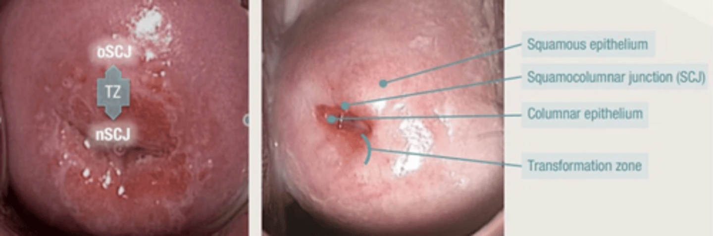 <p>A screening test that collects cells from the transformation zone of the cervix for cytologic evaluation.</p>