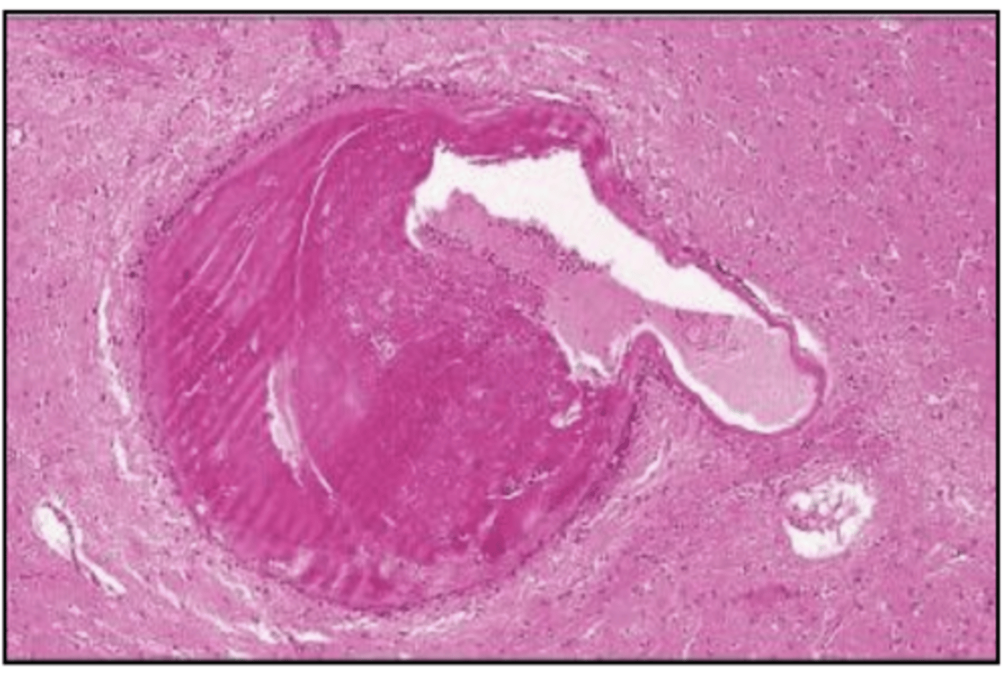 <p>What may dilation and thickening of the arteriole wall in hypertensive small vessel disease predispose a person to?</p>